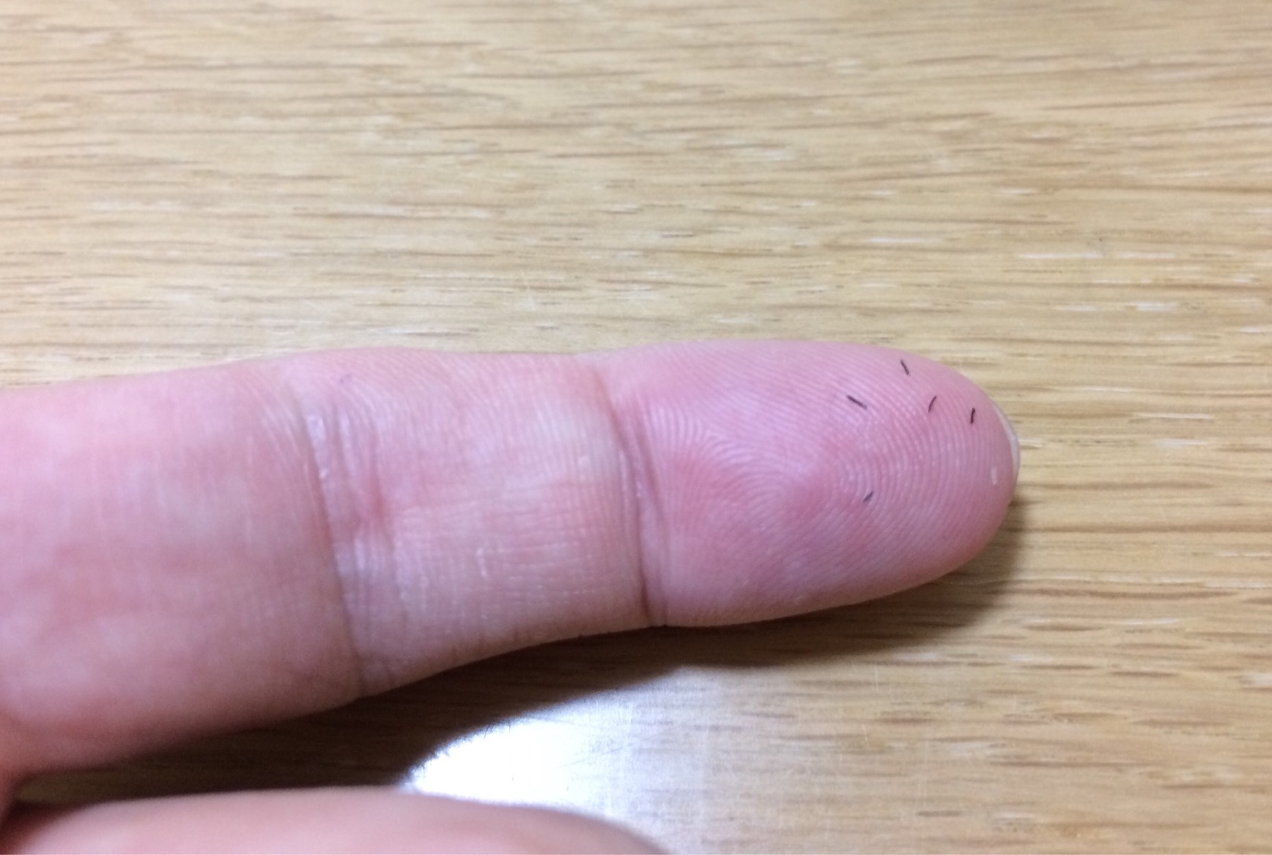 ヒゲ脱毛でツルツルになるまで