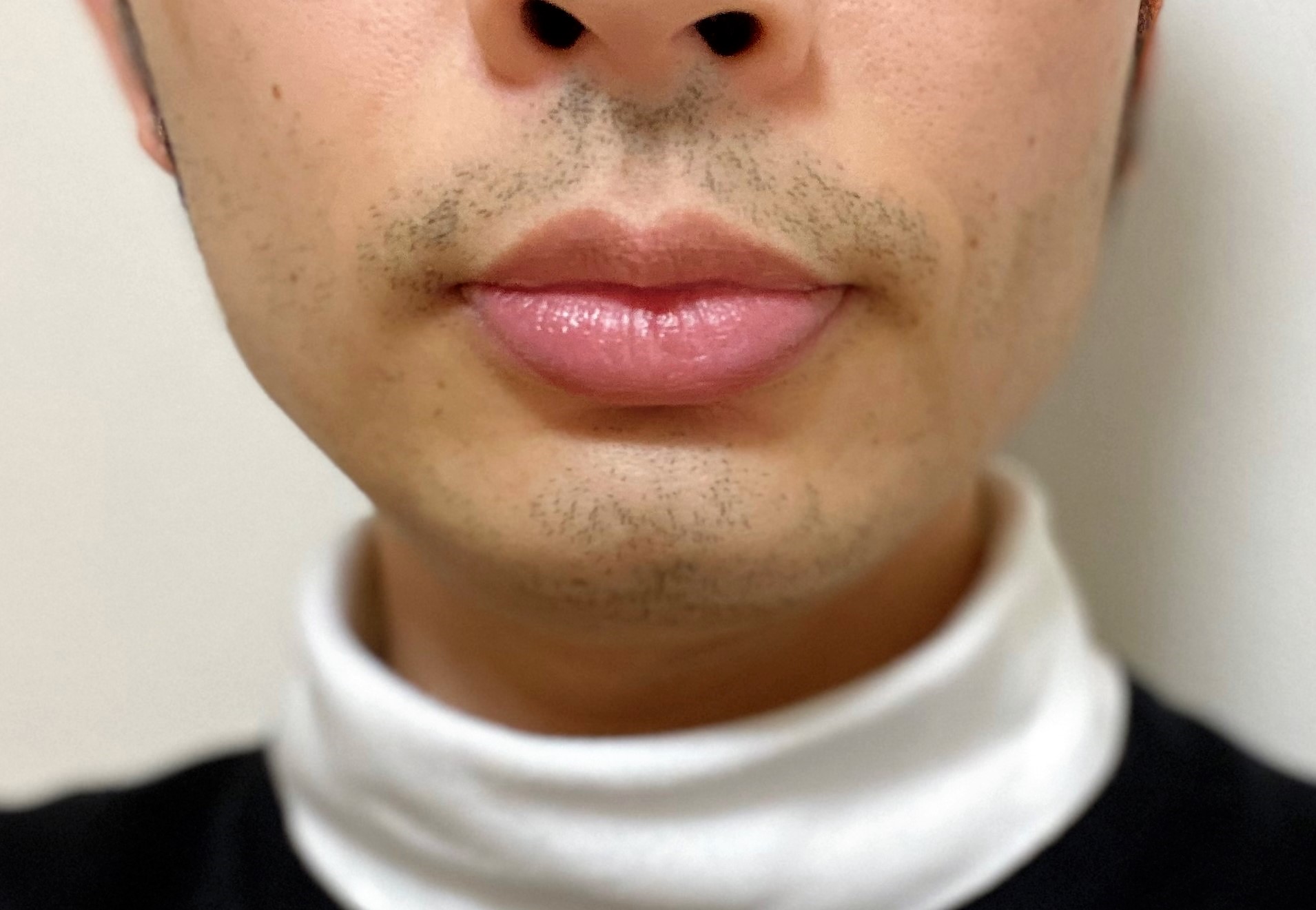 ヒゲ脱毛でツルツルになるまで