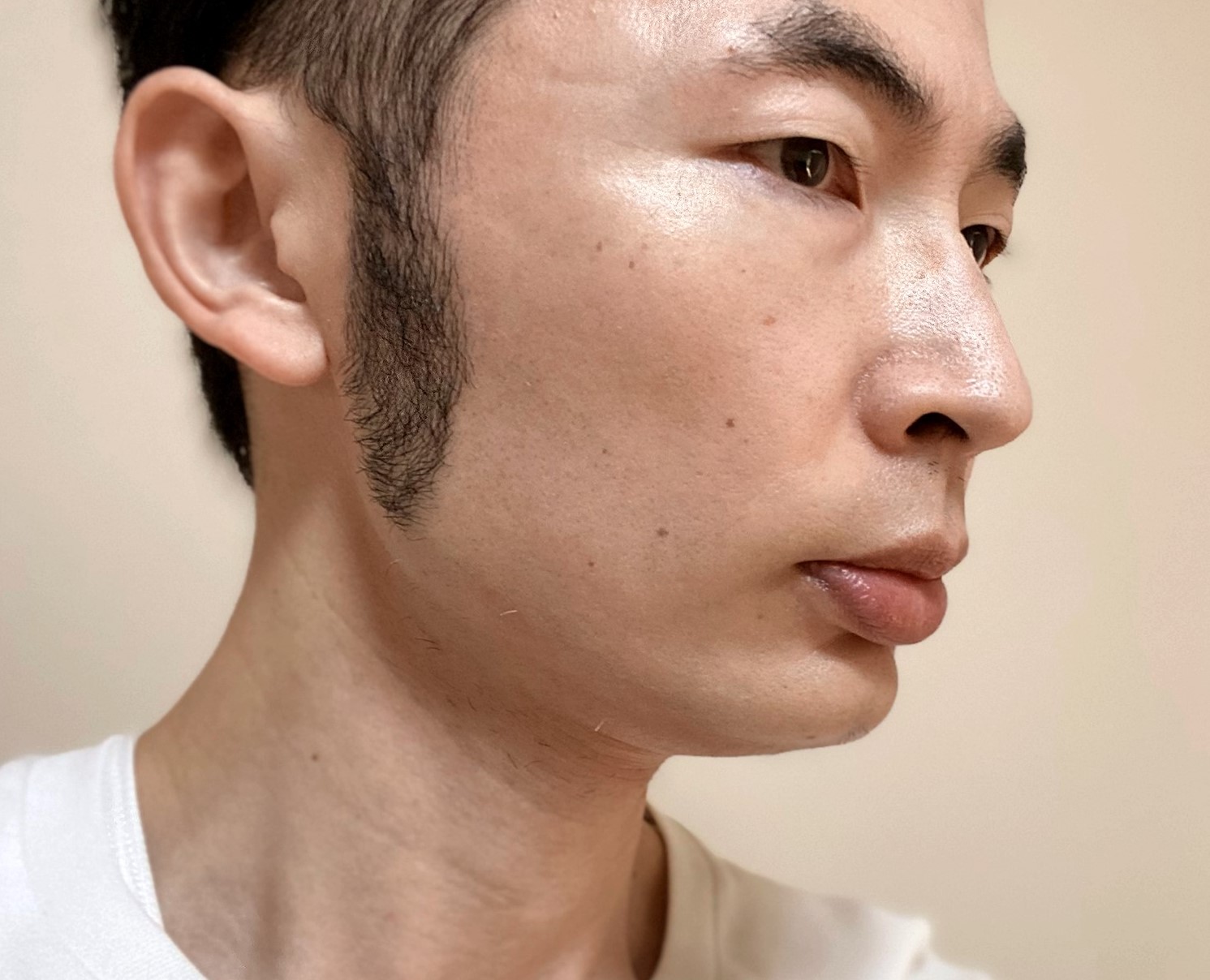 頬ヒゲ脱毛9回目の施術の効果