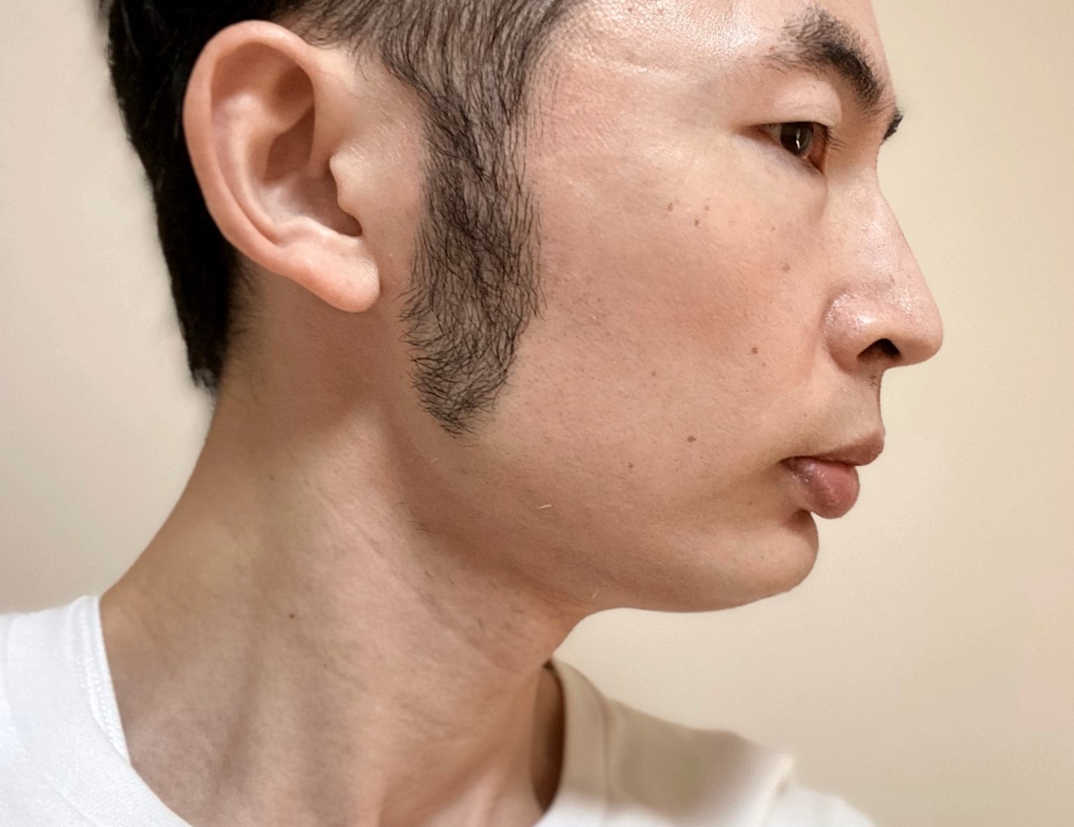 頬ヒゲ脱毛9回目の施術の効果