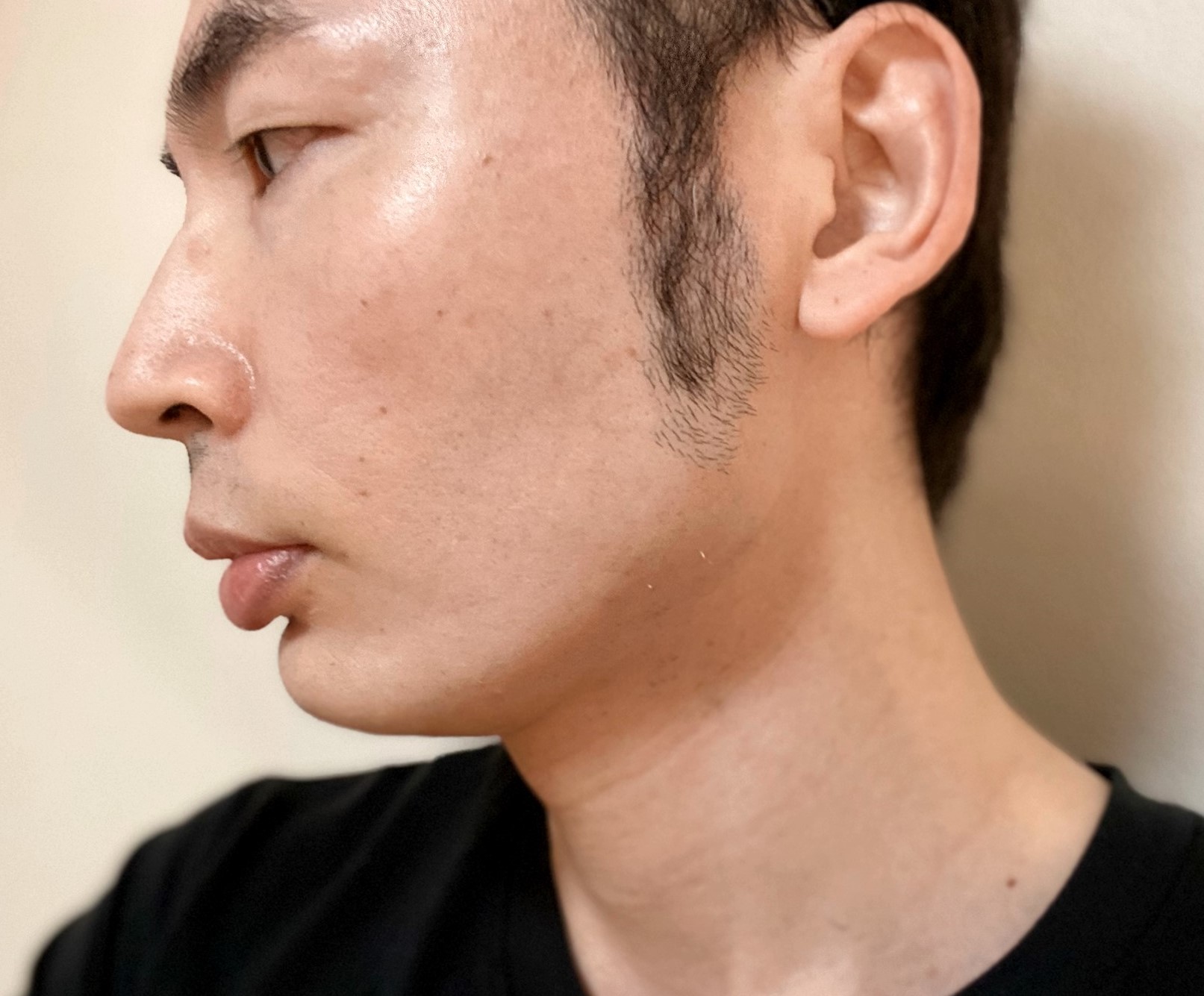 頬ヒゲ脱毛9回目の施術の効果