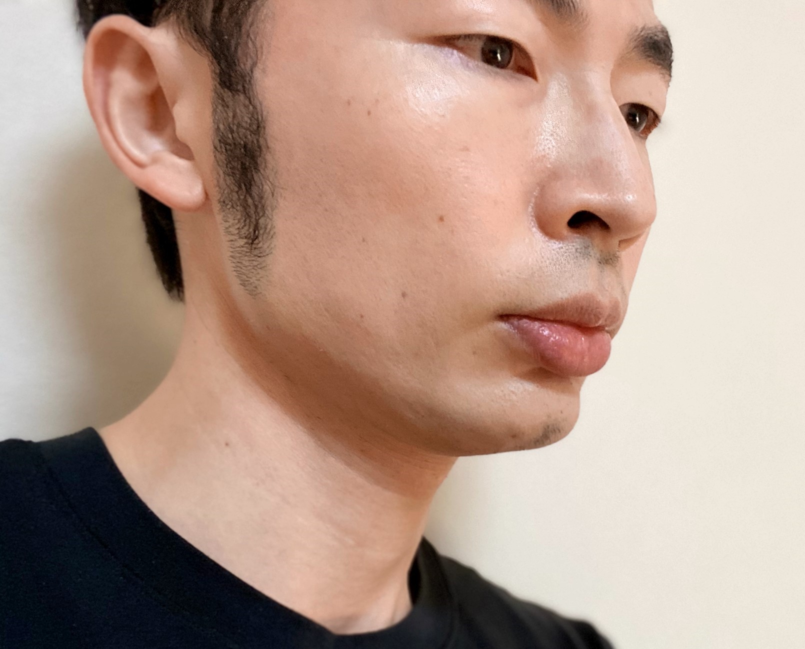 頬ヒゲ脱毛9回目の施術の効果