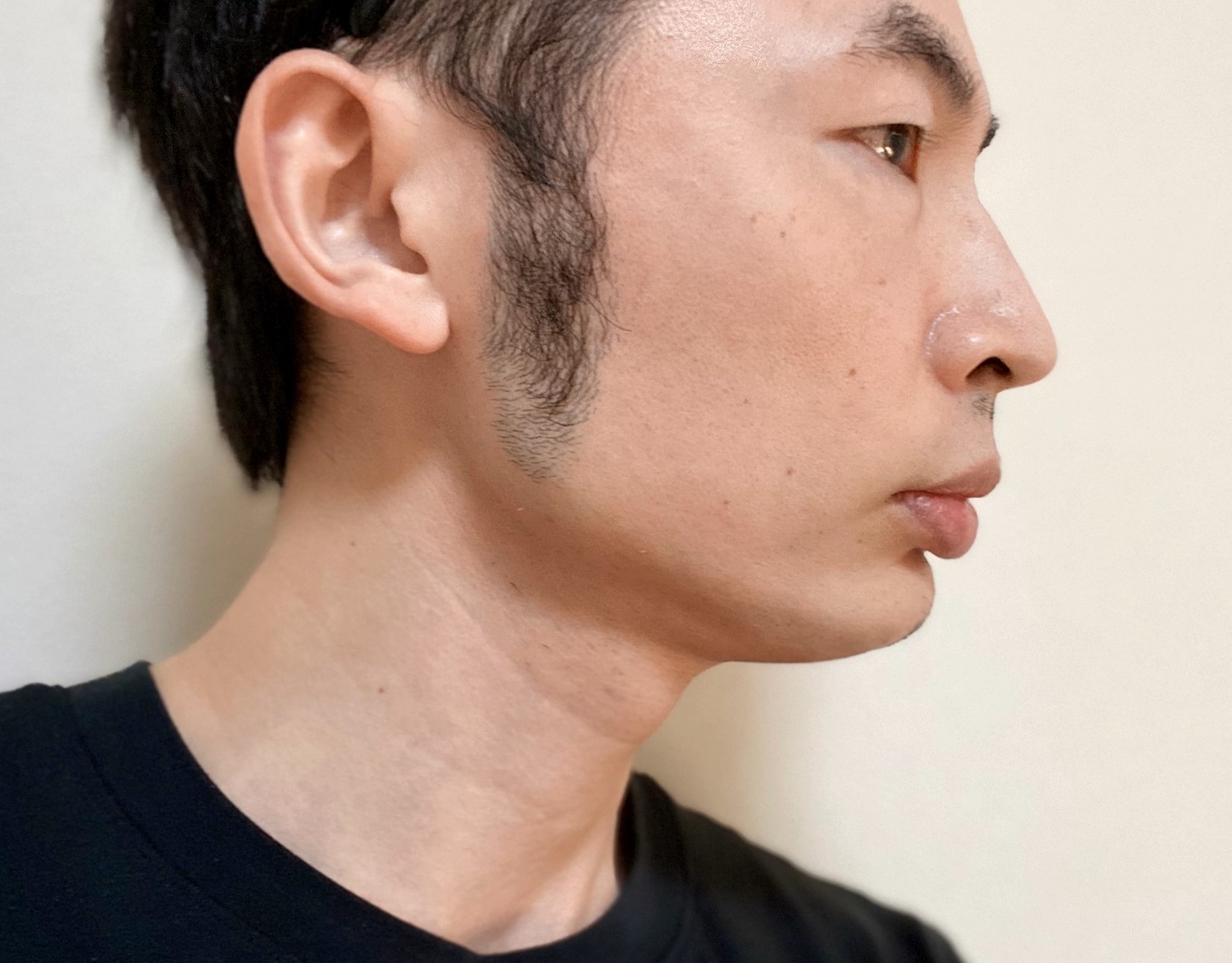 頬ヒゲ脱毛9回目の施術の効果