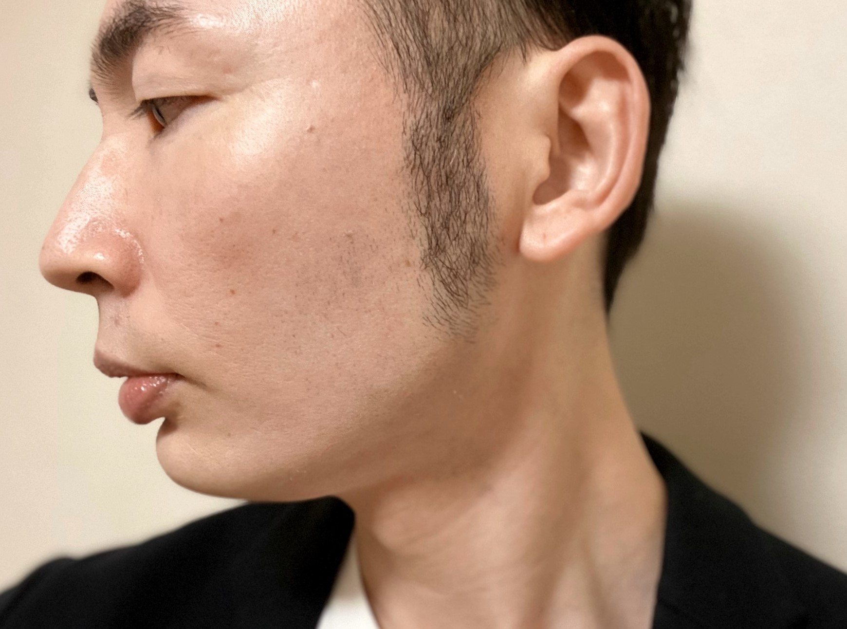 頬ヒゲ脱毛9回目の施術の効果