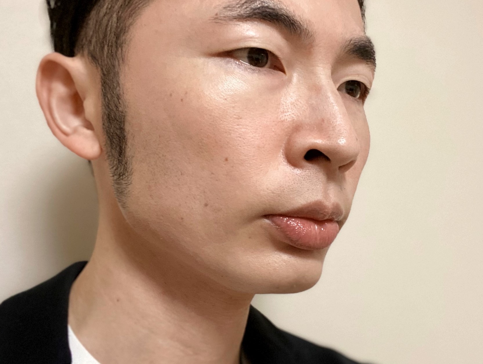 頬ヒゲ脱毛9回目の施術の効果