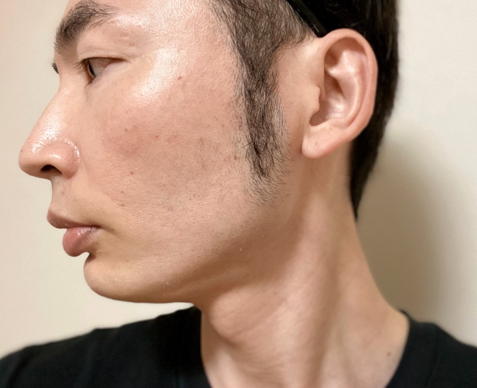 頬ヒゲ脱毛9回目の施術の効果