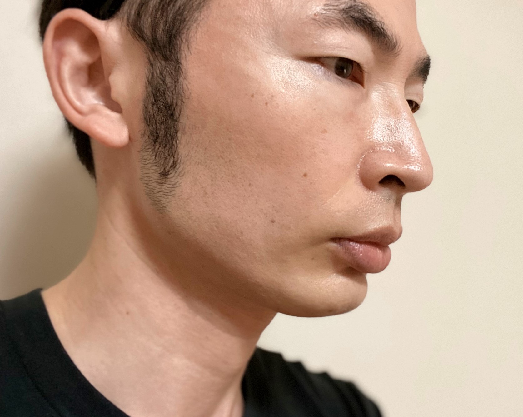 頬ヒゲ脱毛9回目の施術の効果