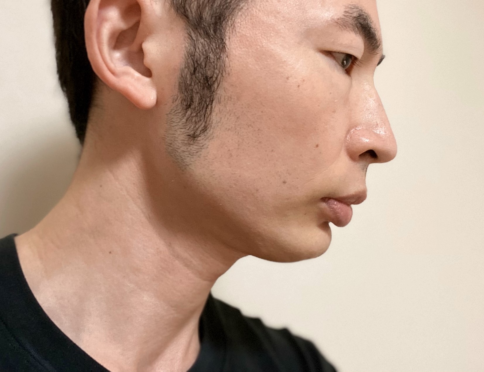 頬ヒゲ脱毛9回目の施術の効果