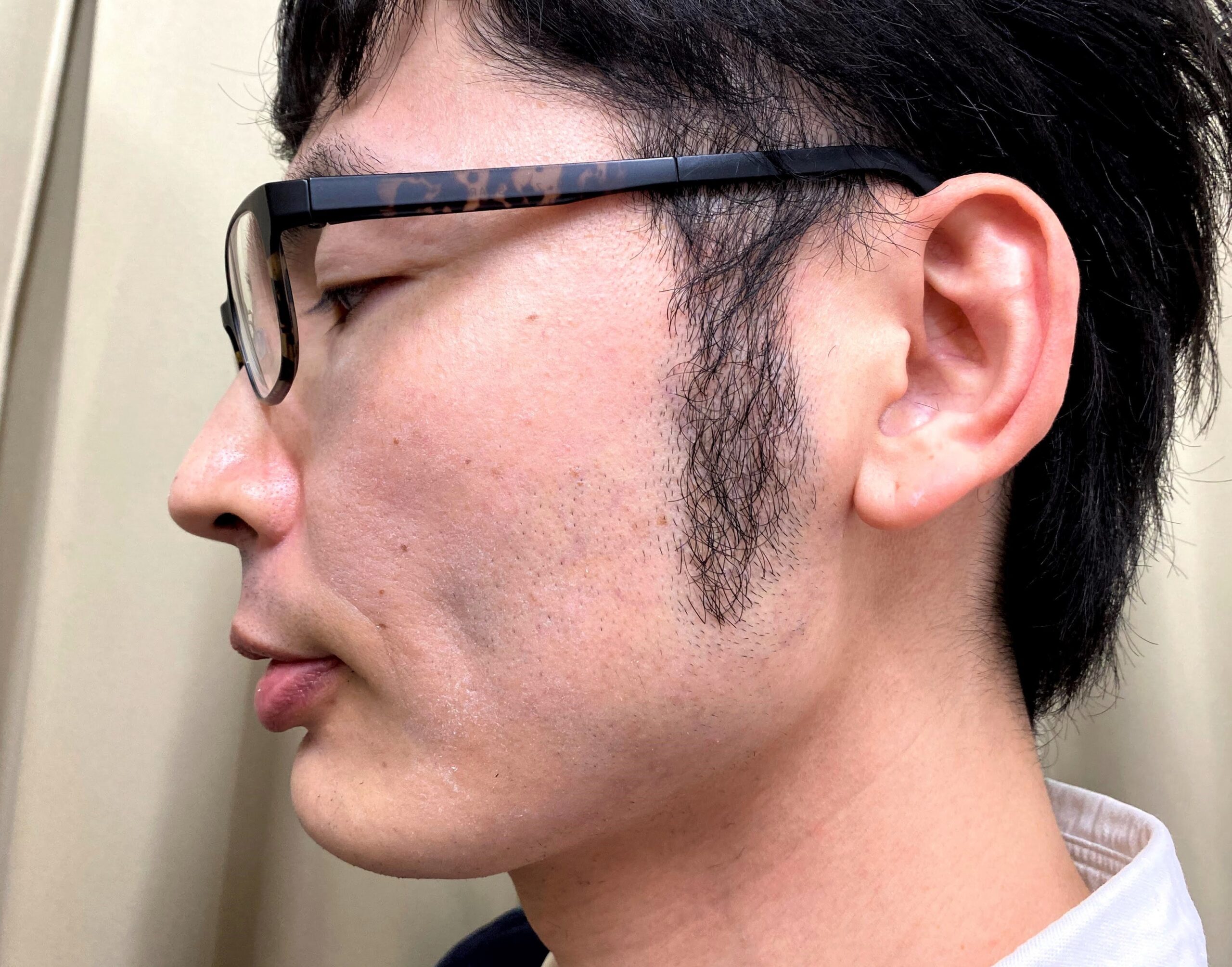 湘南美容クリニックで頬ヒゲ脱毛の施術を受ける前