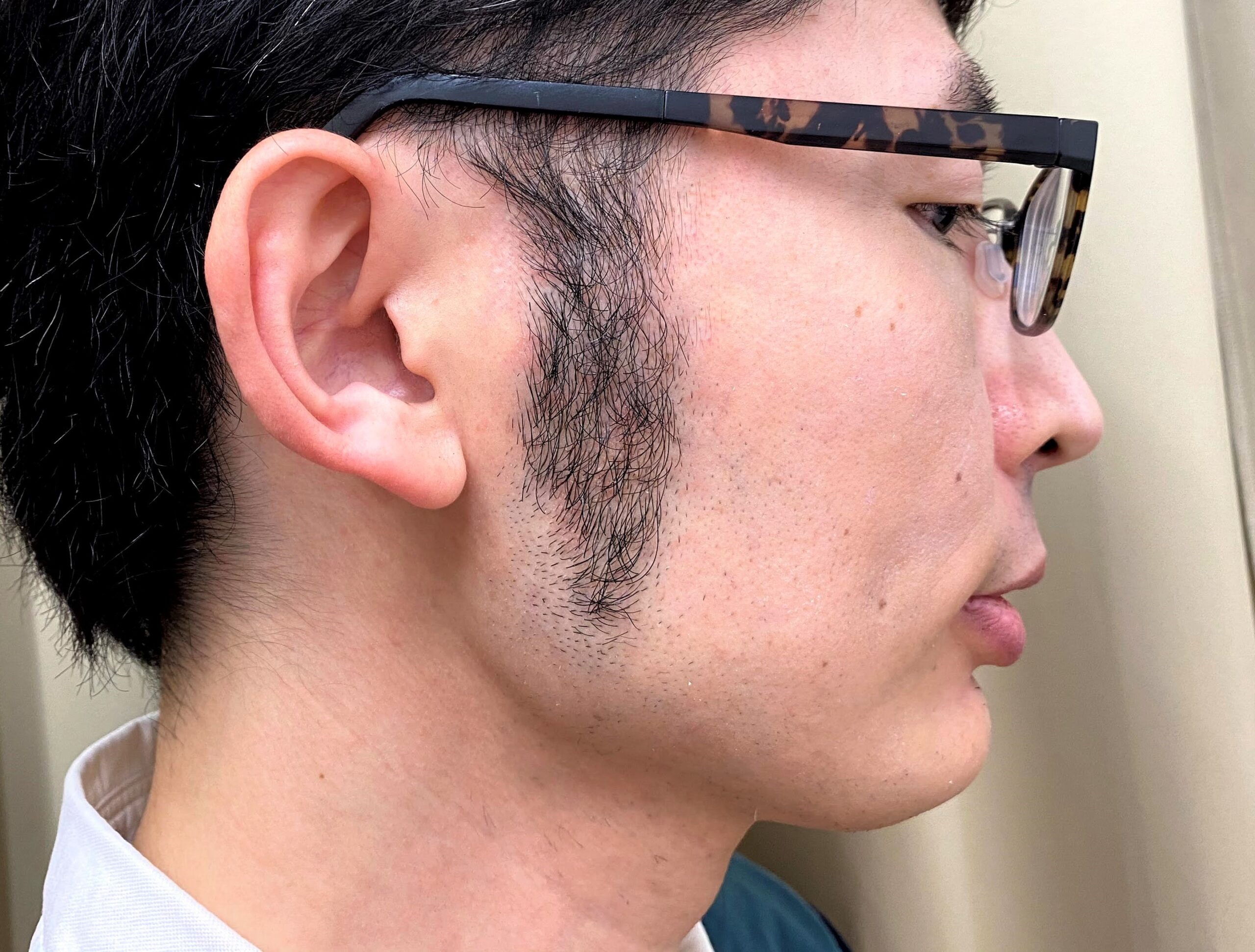 湘南美容クリニックで頬ヒゲ脱毛の施術を受ける前