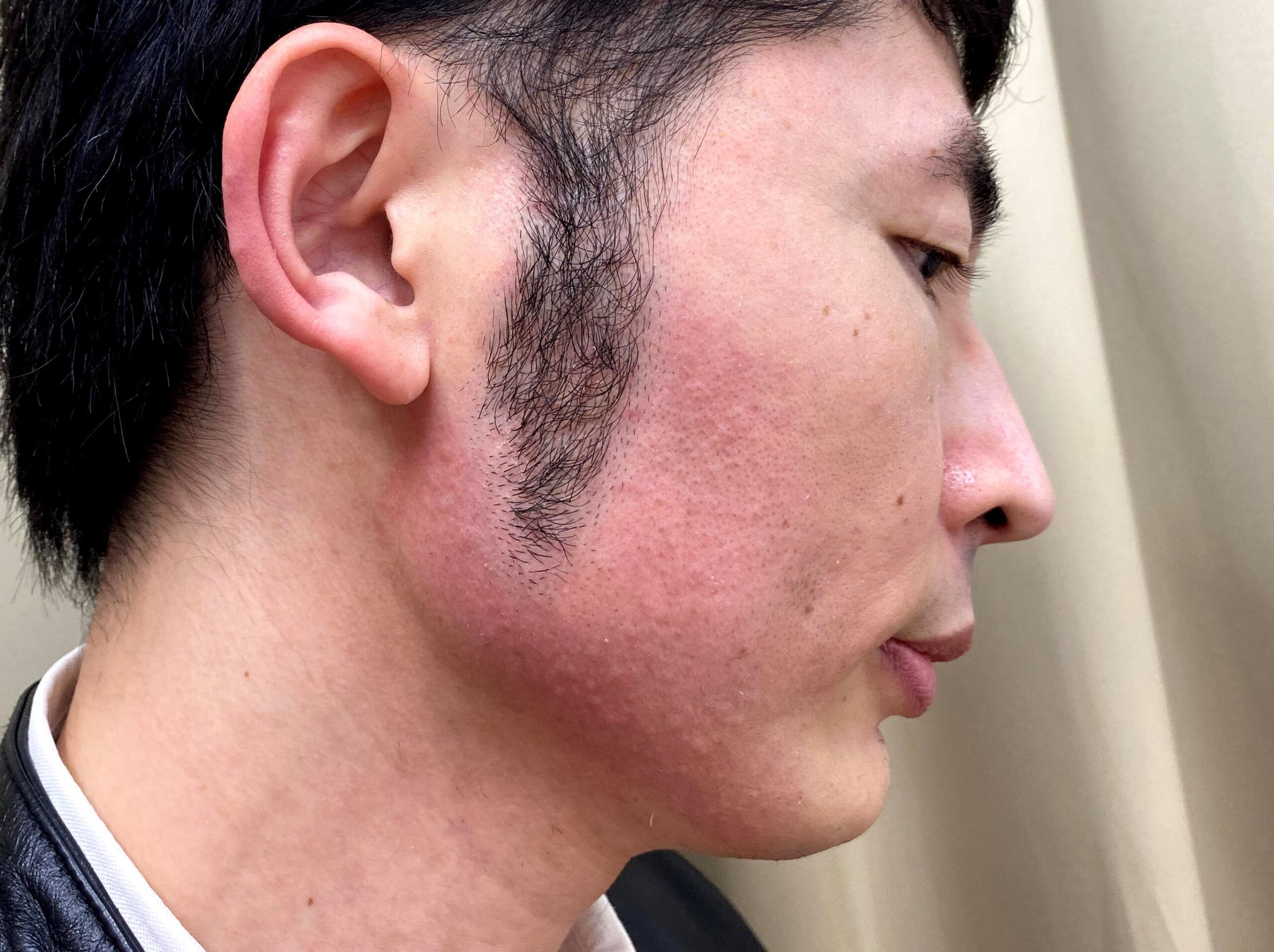 湘南美容クリニックで頬ヒゲ脱毛の施術を受けた後