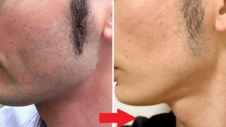 メンズ脱毛レポート 30代医療ライターが徹底取材