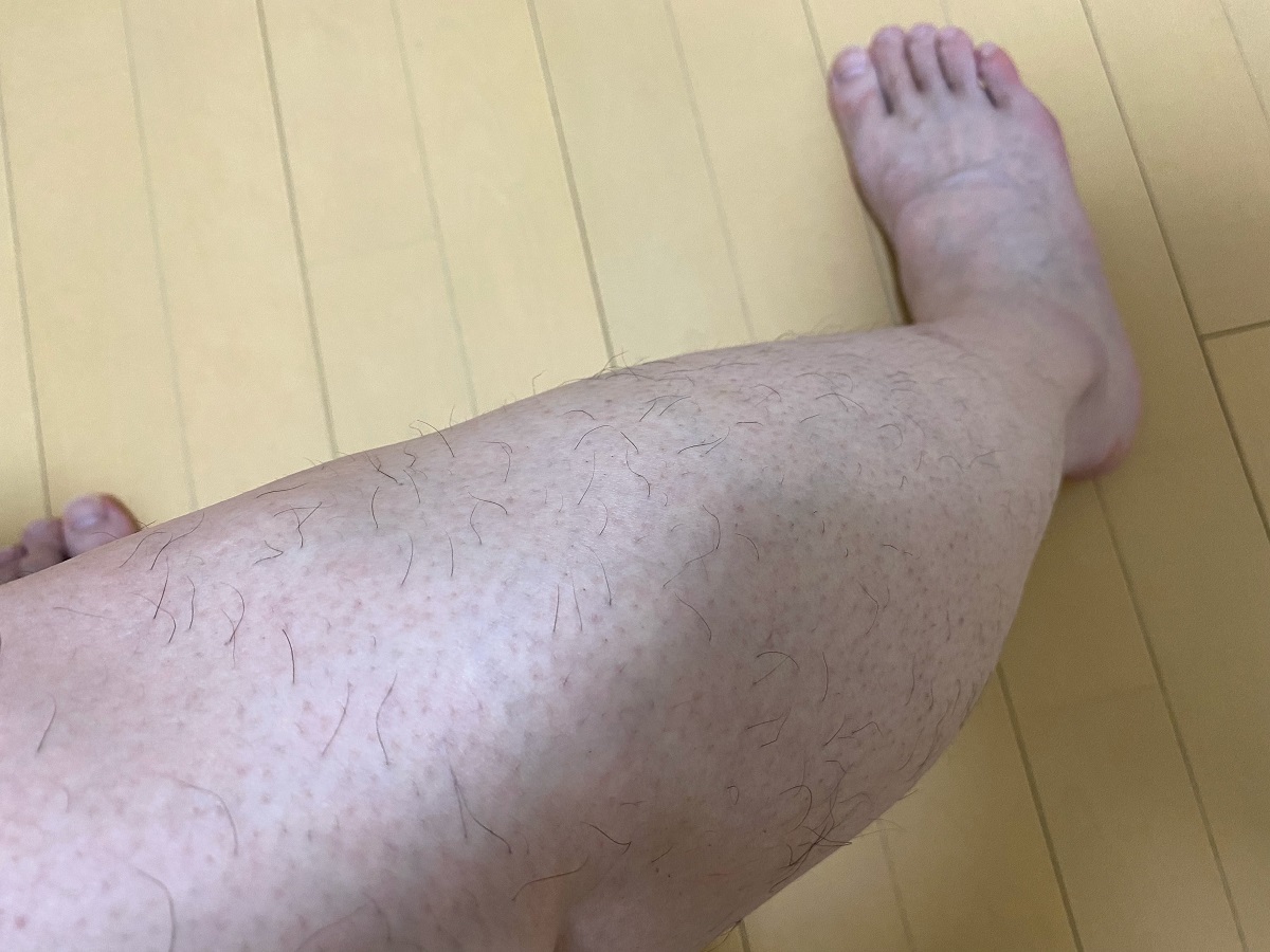 メンズ全身脱毛2回目2カ月後の効果