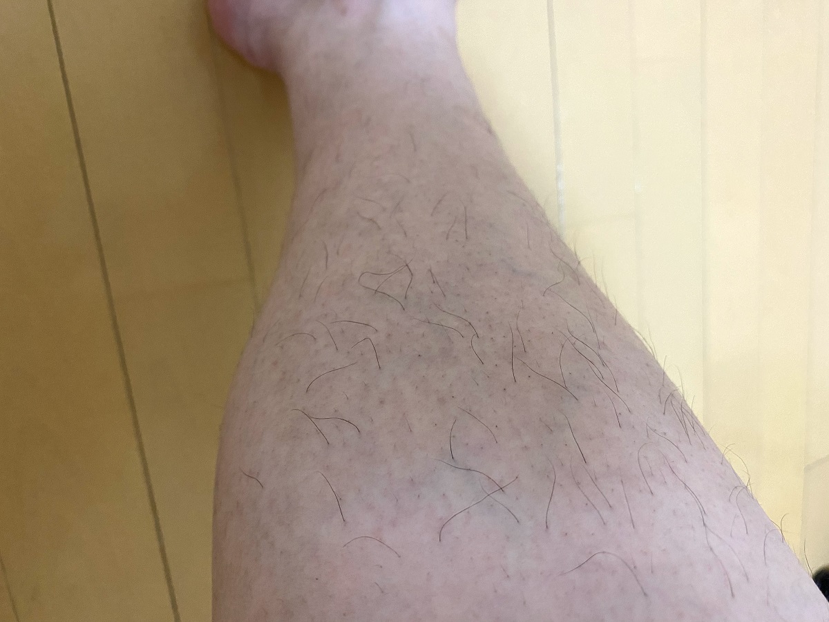 メンズ全身脱毛2回目2カ月後の効果