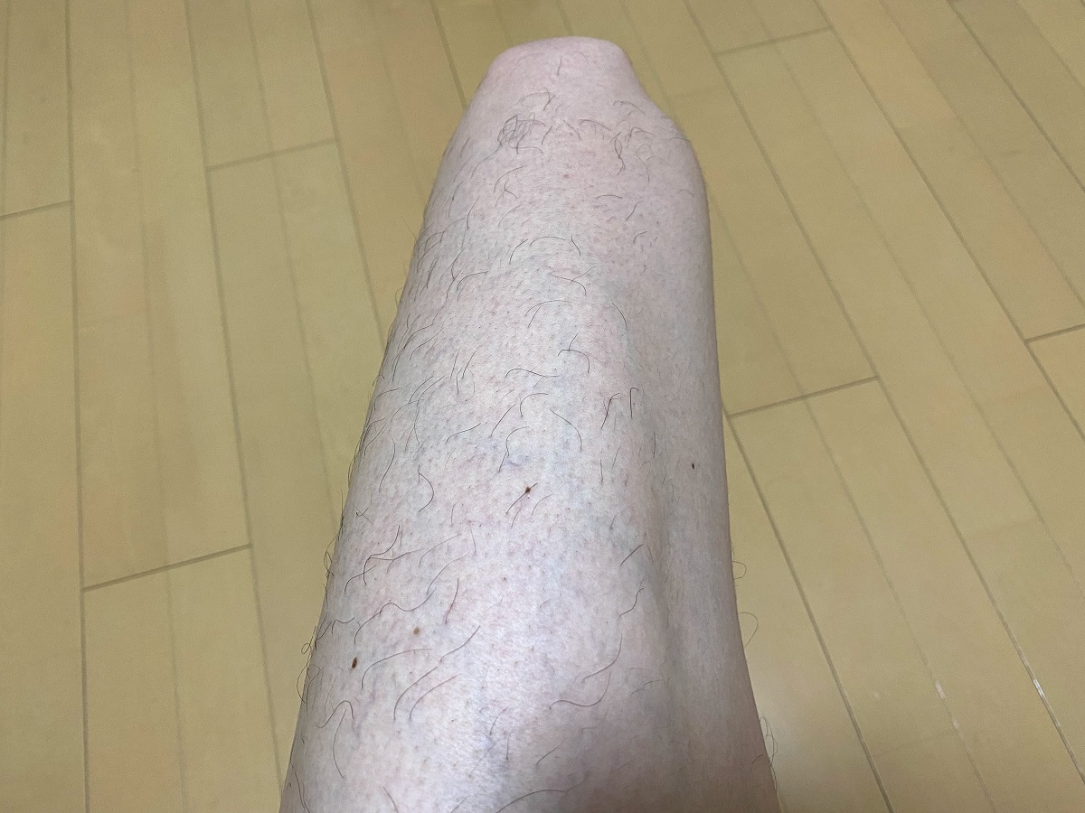 メンズ全身脱毛2回目2カ月後の効果