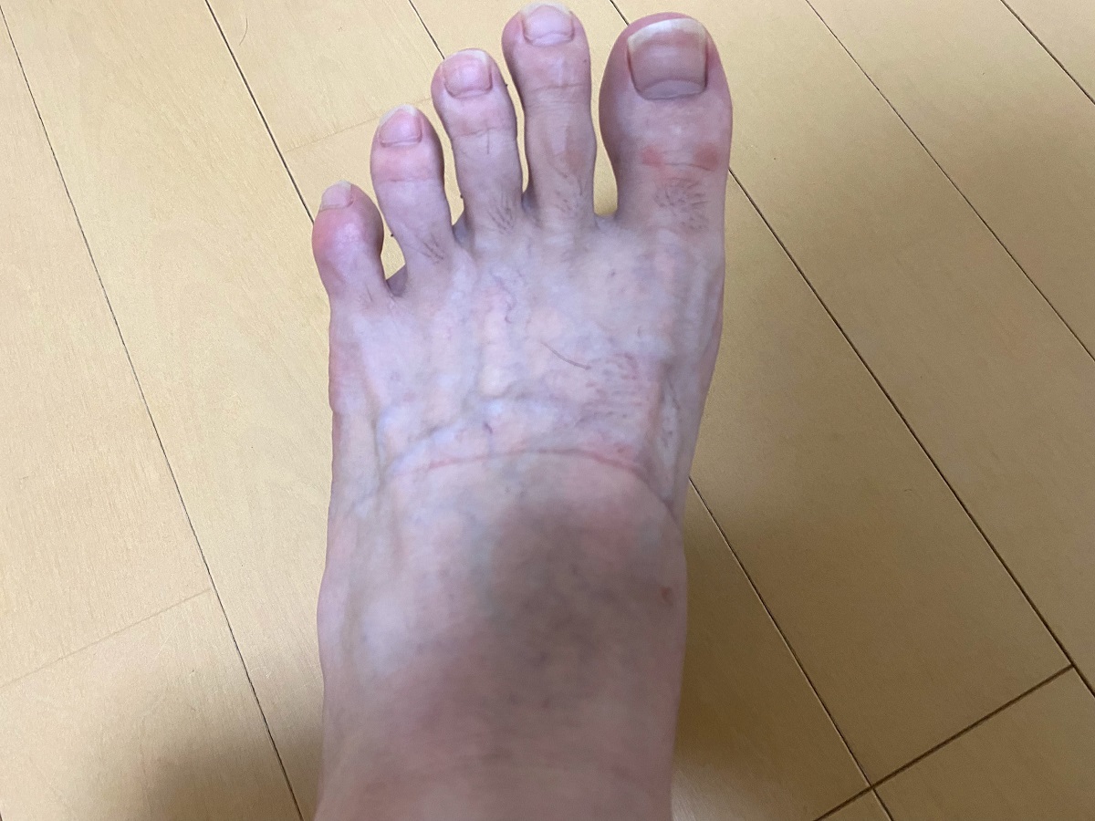 メンズ全身脱毛2回目2カ月後の効果