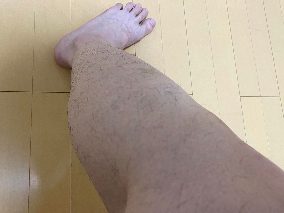 メンズ全身脱毛2回目2カ月後の効果