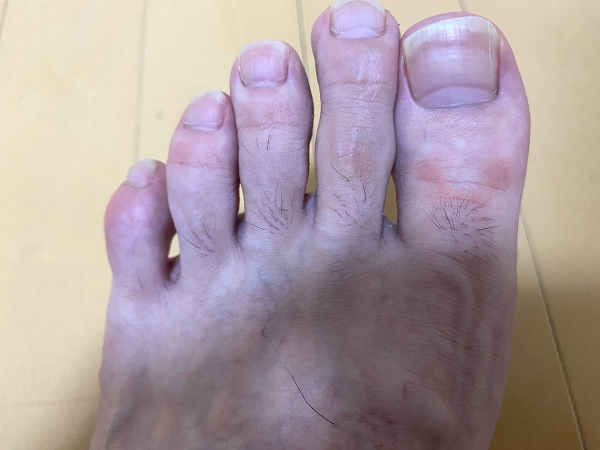 メンズ全身脱毛2回目2カ月後の効果